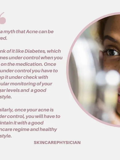 It's a myth that acne can be "cured" permanently. Think of it like a chronic condition that can be controlled with medication and maintained with a consistent skincare regime and healthy lifestyle.