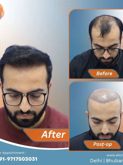 This series shows the full journey: the 'before' state with significant hair loss, the 'post-op' view with freshly implanted grafts, and the final 'after' result with a full, natural head of hair.