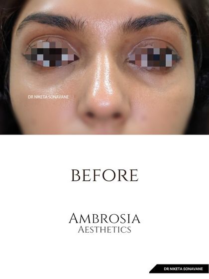 This is the "before" shot of a patient concerned with under-eye hollowness and dark circles, which created a tired appearance.