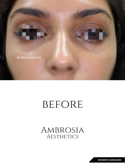 This is the "before" shot of a patient concerned with under-eye hollowness and dark circles, which created a tired appearance.