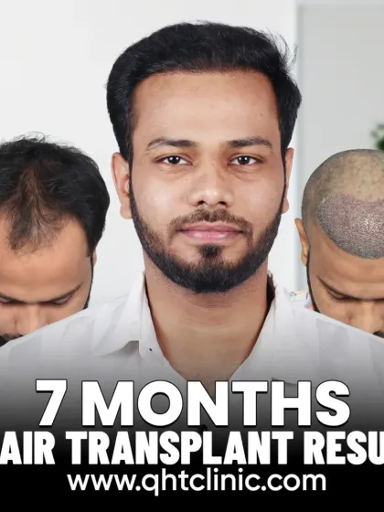 A 7-month transformation for a patient who received 3200 grafts to rebuild his hairline and mid-scalp.