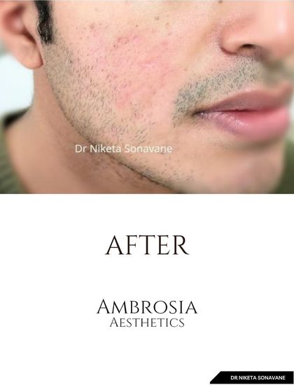After treatment: Following a personalized plan, the patient's skin shows remarkable improvement. The inflammation is gone, and the skin texture is smoother and clearer.