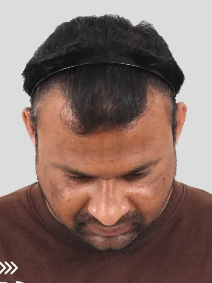 An unbelievable 5-month progress for our Delhi patient. His hairline is already visible, and confidence is restored, with full results still to come.