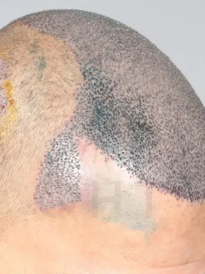 For this Norwood Grade 6 patient, we used 5500 grafts to provide complete coverage, recreating the hairline, frontal part, mid-scalp, crown, and temples.