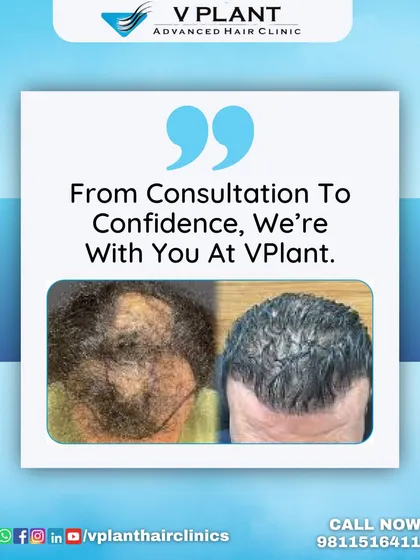 From consultation to confidence, this graphic shows a dramatic before-and-after of a scalp with severe hair loss transformed into a head with dense, new growth.