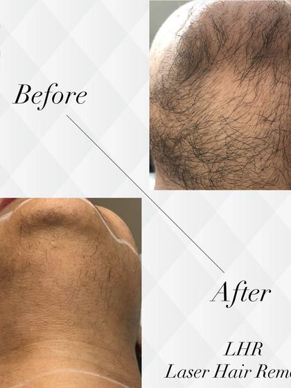 This image showcases the results of laser hair removal for a male client's beard line and neck. The treatment provides a clean, well-defined look and helps prevent razor bumps.