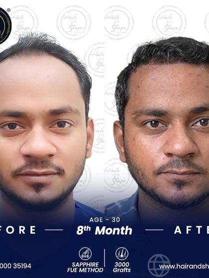 Just 8 months after his Sapphire FUE transplant of 3000 grafts, this patient has a fuller, more defined hairline and a completely revitalized look.