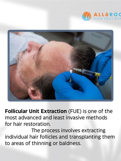 This series explains the Follicular Unit Extraction (FUE) technique. It is a minimally invasive method where I extract individual hair follicles and transplant them, resulting in minimal scarring and natural-looking, permanent hair.