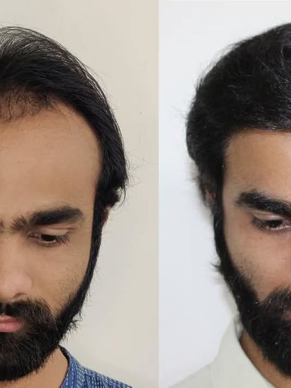 This patient's transformation is remarkable. We focused on creating a strong, dense hairline that completely changed his appearance and restored his confidence.