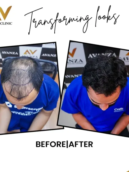 A successful transplant is all in the details. The 'before' image shows the precise hairline I designed for this client, mapping out a natural and face-framing shape. The 'after' image shows the final result, a full head of hair where the new growth blends seamlessly.