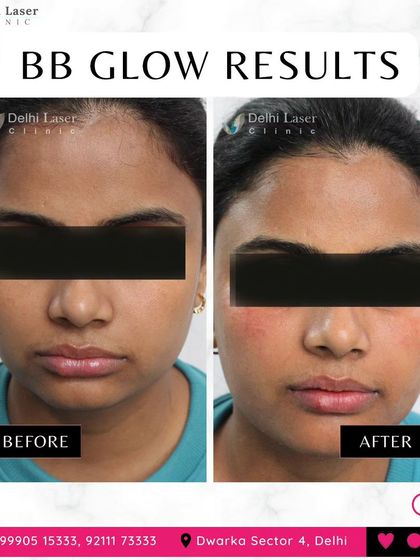 Here is another fantastic result from our BB Glow facial. You can see the improvement in skin texture and the reduction of minor blemishes. The after photo shows a healthy, radiant glow that looks natural and fresh.