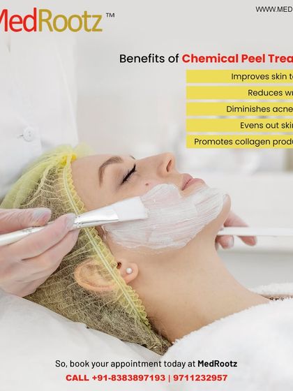 This graphic summarizes the key benefits of a chemical peel. The treatment improves skin texture, reduces wrinkles, diminishes acne scars, evens out skin tone, and promotes collagen production for healthier skin.