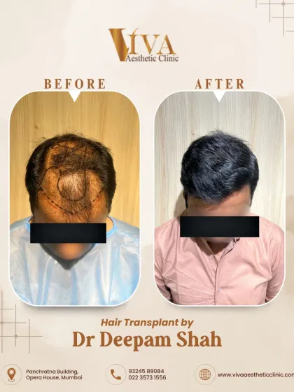 A top-down comparison for the same Grade 4 case. You can see the initial hairline design and the final result after 10 months, showing complete coverage of the previously bald area.
