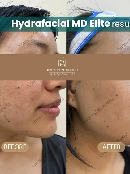 This before-and-after showcases the immediate results of a single Hydrafacial MD Elite session. Notice the visible reduction in pigmentation and uneven texture, and the significant improvement in overall skin clarity and radiance. This is the kind of healthy, hydrated glow you can expect.