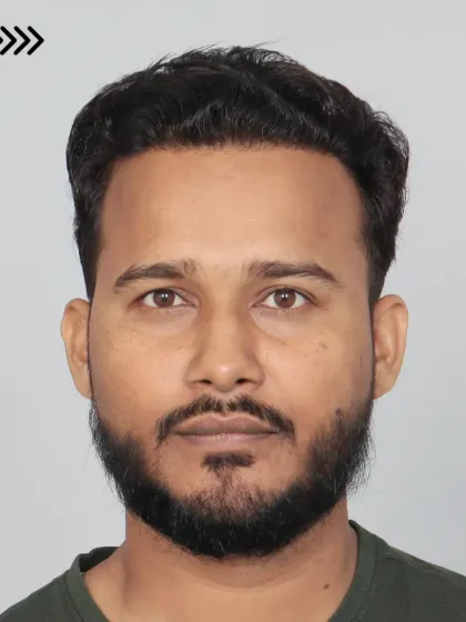 A remarkable 9-month transformation. We used 5000 grafts for hairline restoration and mid-scalp coverage, resulting in visible volume and confidence.