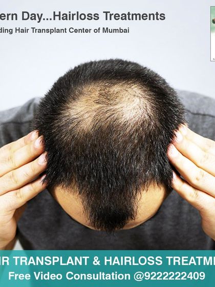 This image shows a common pattern of hair loss known as crown balding. We offer modern hair loss treatments, from non surgical therapies to advanced hair transplants, to effectively address this and restore density to the crown area.