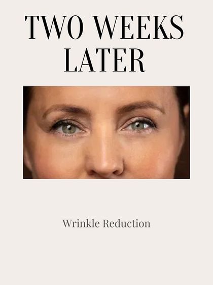 Clinic Next Face - Cosmetic Injectables Botox Treatments: Smooth Wrinkles & Refine Contours photo 10