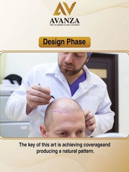 The Design Phase is the first and most crucial artistic step. We work with you to design a hairline that achieves natural coverage and a pattern that suits your facial features and age.