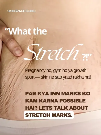 What are stretch marks? Whether from pregnancy, gym growth, or puberty, they are signs that your skin has adapted to change. We offer advanced treatments to help reduce their appearance and improve skin texture.