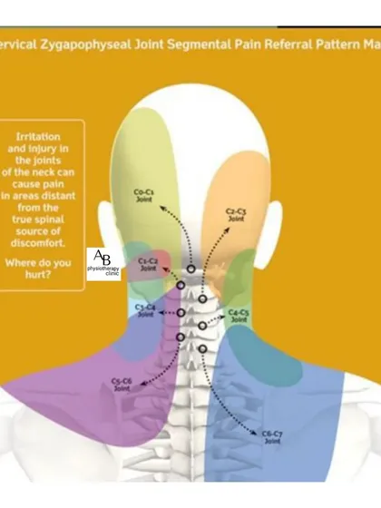 Neck pain can be complex. This map shows how irritation in a specific neck joint can refer pain to the head, shoulder, or upper back. We are trained to trace this pain back to its source.