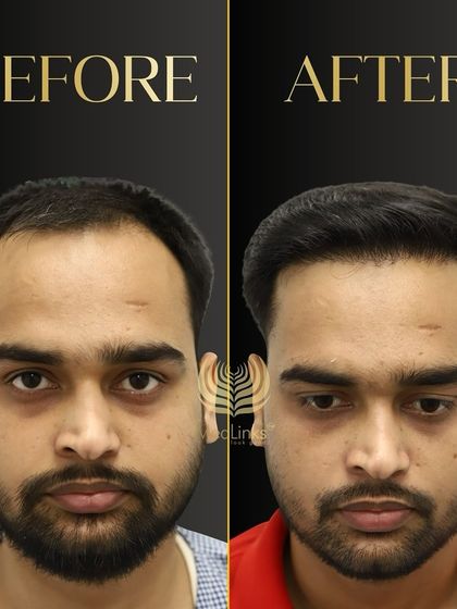 A fantastic before and after result. The patient's new hair looks natural, dense, and has completely revitalized his appearance.