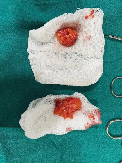 These are the buccal fat pads that were removed from a patient's cheeks. Removing this specific pocket of fat helps to slim the lower face, enhancing the natural bone structure for a more defined look.