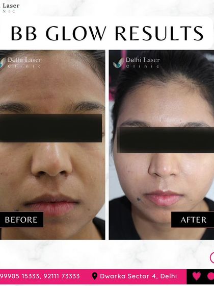 The results of our BB Glow treatment speak for themselves. This client's skin tone is visibly more even, with reduced patchiness and a brighter complexion after the session. It provides a flawless base without the need for daily foundation.