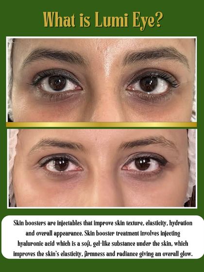 Tired eyes and dark circles? Lumi Eyes is an under-eye skin booster that uses hyaluronic acid to improve skin texture, elasticity, and hydration, giving an overall brighter and refreshed appearance.