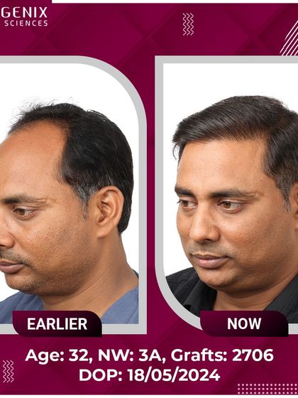 A 32-year-old patient's journey from Grade 3A baldness to a full, confident look after 2706 grafts.