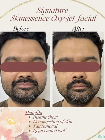 This client achieved an instant glow and a more even complexion after my signature Oxy-jet Medi-facial. The treatment effectively removed tan and decongested the skin, leaving it looking bright and rejuvenated with no downtime.