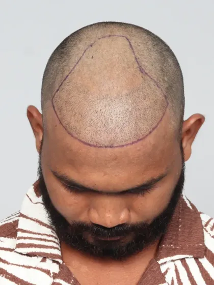 The before, marking, and after stages of a hair transplant, showing the clear plan and the resulting growth.