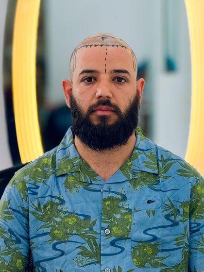 A frontal view of a patient ready for his transplant. The background shows our well lit and professional setup, ensuring you are in good hands.