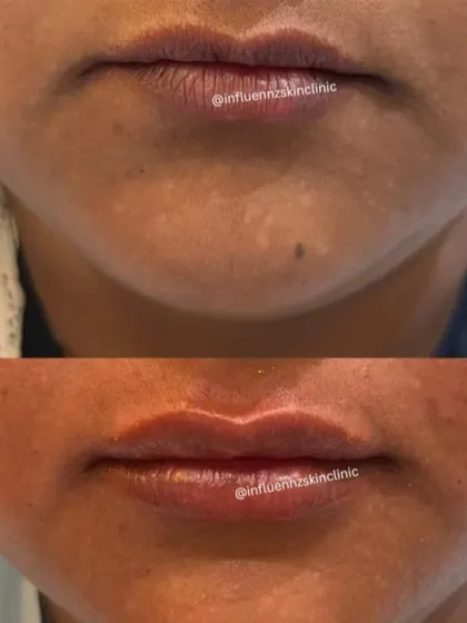 This before and after image shows how we can add definition and volume to the lips for a natural, puckered-up look.