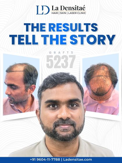 For Mr. Koushik Verma, this transformation was about seeing himself in the mirror again. With 5,237 grafts, I was able to address widespread thinning and restore a full head of hair, bringing back the confidence he had been missing.
