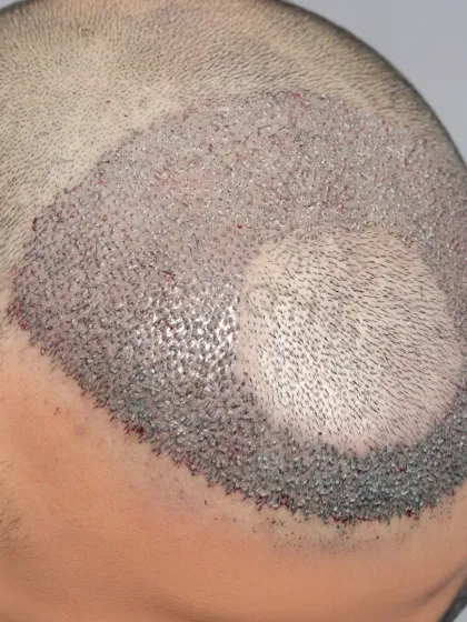 A high-density hair transplant where we preserved the patient's natural frontal tuft while restoring the surrounding areas with 3500 grafts.