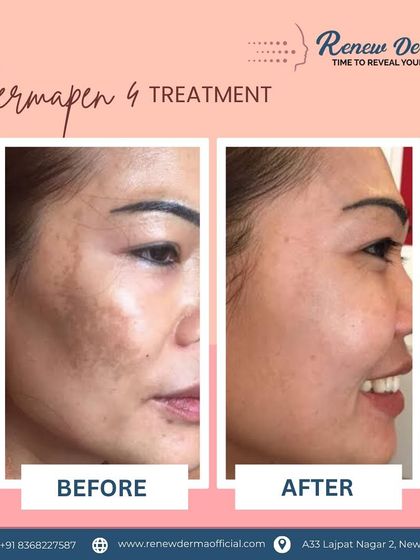 A powerful before and after example of our Dermapen 4 treatment for pigmentation. You can see a significant reduction in hyperpigmentation and a more even, clearer skin tone after just a few sessions.