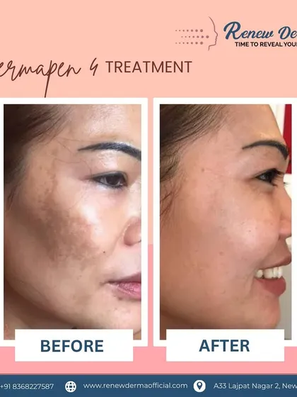 A stunning transformation using Dermapen 4. This treatment effectively addressed deep pigmentation and uneven texture, leaving the skin visibly clearer and brighter.