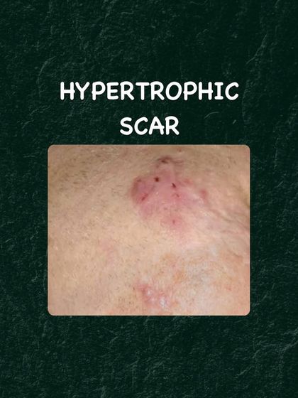 Unlike other acne scars, hypertrophic scars are raised above the skin's surface. Managing them requires a different approach to reduce their volume and visibility.
