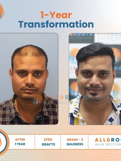 This one-year transformation for a Grade 3 baldness case was achieved with 2750 grafts. The series of photos demonstrates the significant improvement in density and hairline from every angle.