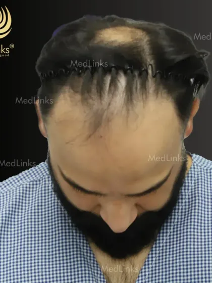 The journey to new hair begins. This image shows a patient's hair styled to reveal the thinning area, just before starting the restoration process that will bring back a fuller look.
