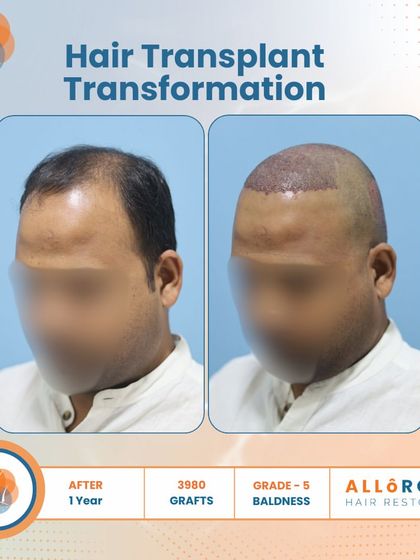 A one-year transformation for a Grade 5 baldness case using 3980 grafts. The images show the before, the immediate post-op, and the final result, demonstrating the entire process and its successful outcome.