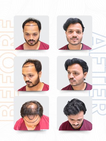 This six-panel grid shows Mr. Tushar's complete transformation. From the initial hairline design to the final dense result, every step was planned to ensure his new hair looks and feels completely natural from every viewpoint.