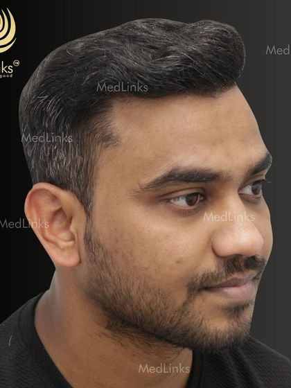 The final result from the side, showing a natural and dense hairline.