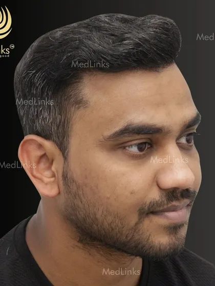 The final result from the side, showing a natural and dense hairline.