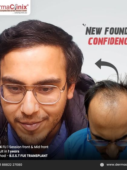 The smile says it all. This patient regained his confidence after a 4624 graft B.E.S.T. FUE transplant. The one year result shows a complete transformation from significant balding to a full head of hair.