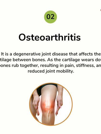 Osteoarthritis occurs when cartilage wears down, causing bones to rub together. My approach focuses on lubricating the joints and reducing inflammation to manage pain and slow the progression of this degenerative joint disease.