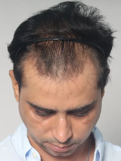 A 20-month transformation for a Diffuse Grade 5A patient. With 3800 grafts, we restored his hairline, frontal region, and mid-scalp for a lasting, natural look.