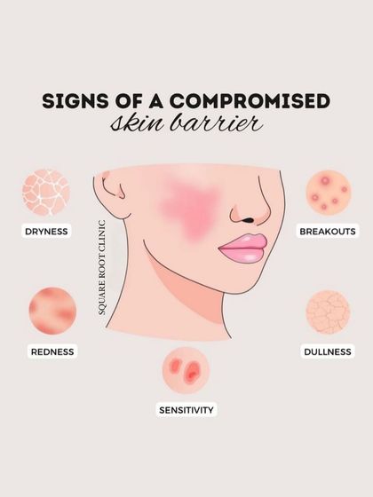An educational infographic showing the common signs of a compromised skin barrier. These include dryness, redness, breakouts, dullness, and sensitivity, all of which we can help you address.