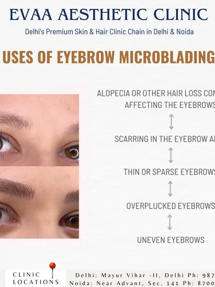 This graphic outlines the primary applications for eyebrow microblading. We recommend this treatment for clients with conditions like alopecia, scarring, thin or sparse eyebrows, overplucked brows, and unevenness.