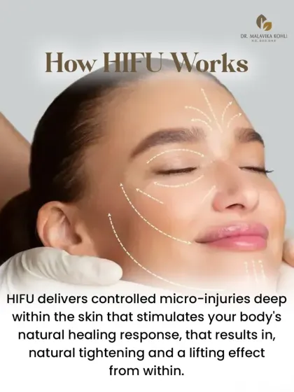 HIFU works by delivering controlled micro-injuries deep within the skin. This process stimulates your body’s natural healing response, leading to the production of new collagen and a tightening effect from within.